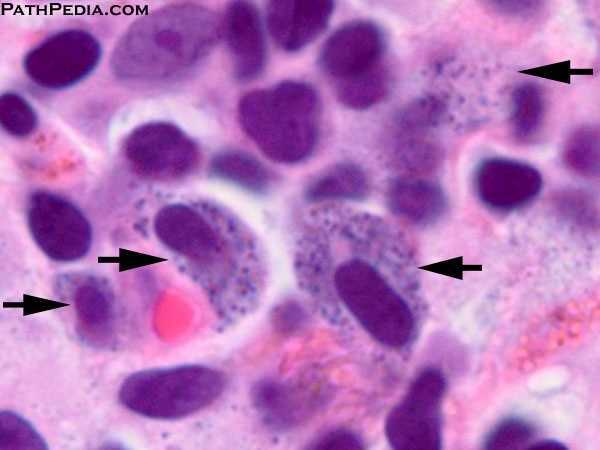 mastocytosis-systemic-indolent-[2-bm101-2]