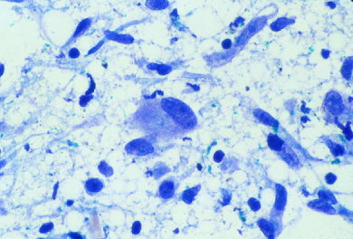 Figure-3-Aspiration-smears-of-fibromatosis-show-isolated-plump-fibroblasts-without.png