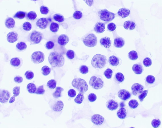 Figure-3-Malignant-lymphoma-Large-discohesive-cells-with-irregular-nuclear-membrane.png