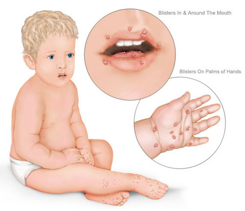 Hand-Foot-and-Mouth-Disease1.jpg