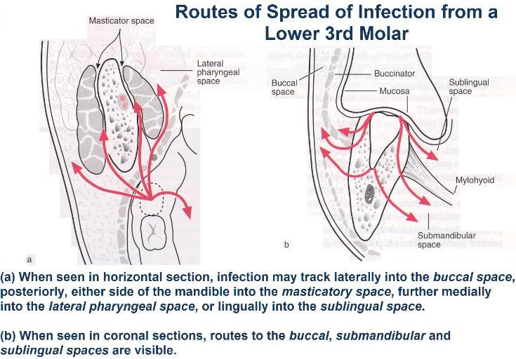 Routes_of_Spread_of_Infection_from_a_Lower_3rd_Molar2-735x512.jpg