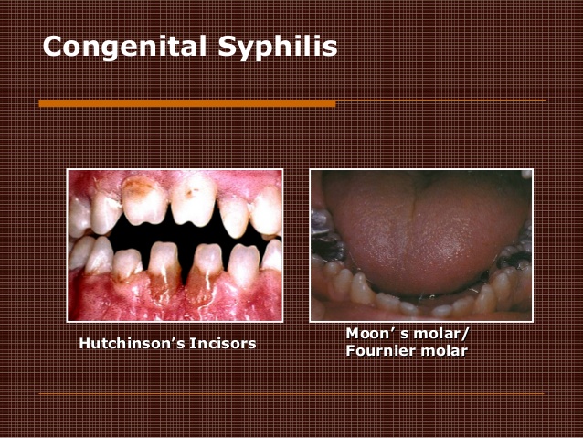developmental-distrubances-of-teeth-77-638.jpg